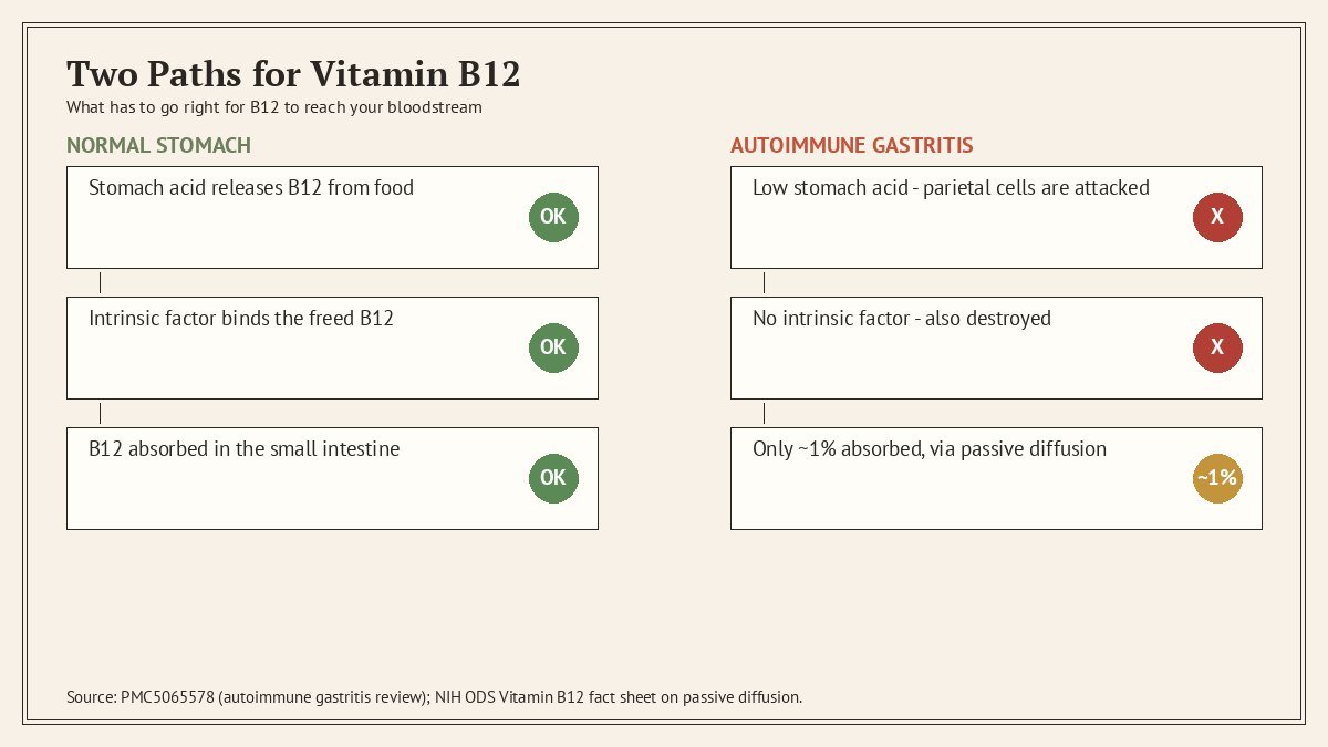 diagram showing how autoimmune gastritis blocks vitamin B12 absorption